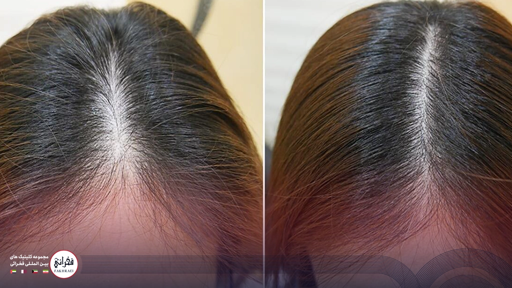 هیر فیلر-موی سر خانمی قبل بعد از هیرفیلر