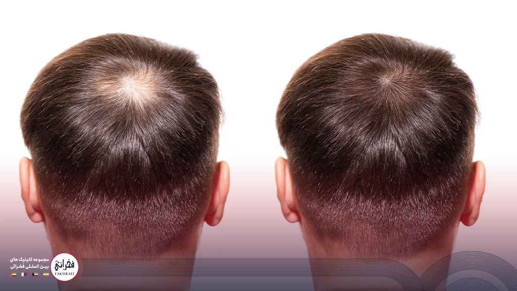 هیر فیلر-قبل و بعد مردی با تزریق موی سر
