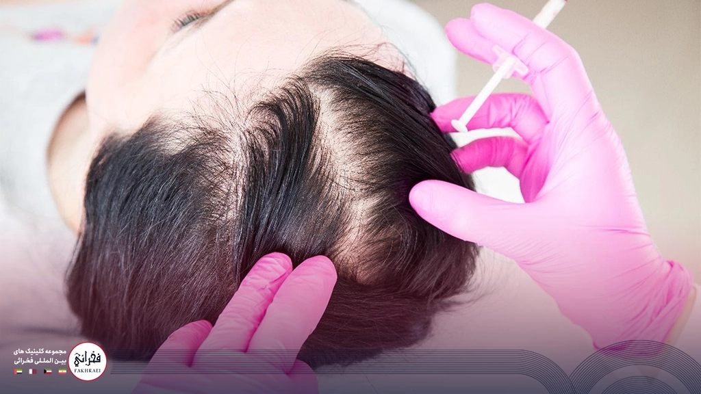 هیر فیلر-در حال تزریق فیلر به موهای خانمی