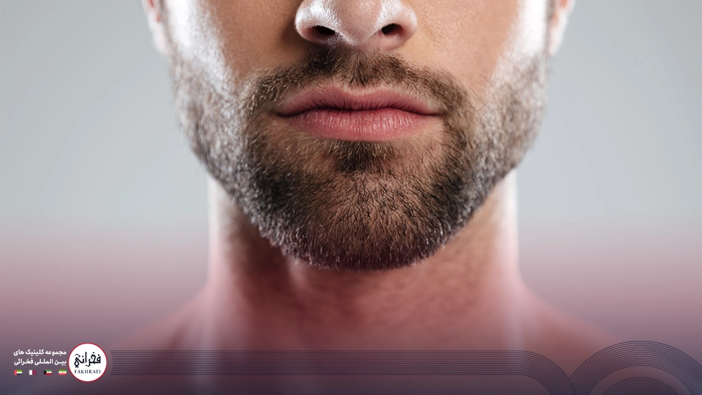 مزوتراپی ریش-ته ریش مرتب مردی