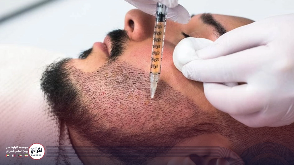 مزوتراپی ریش-مزوتراپی ریش روی صورت مردی