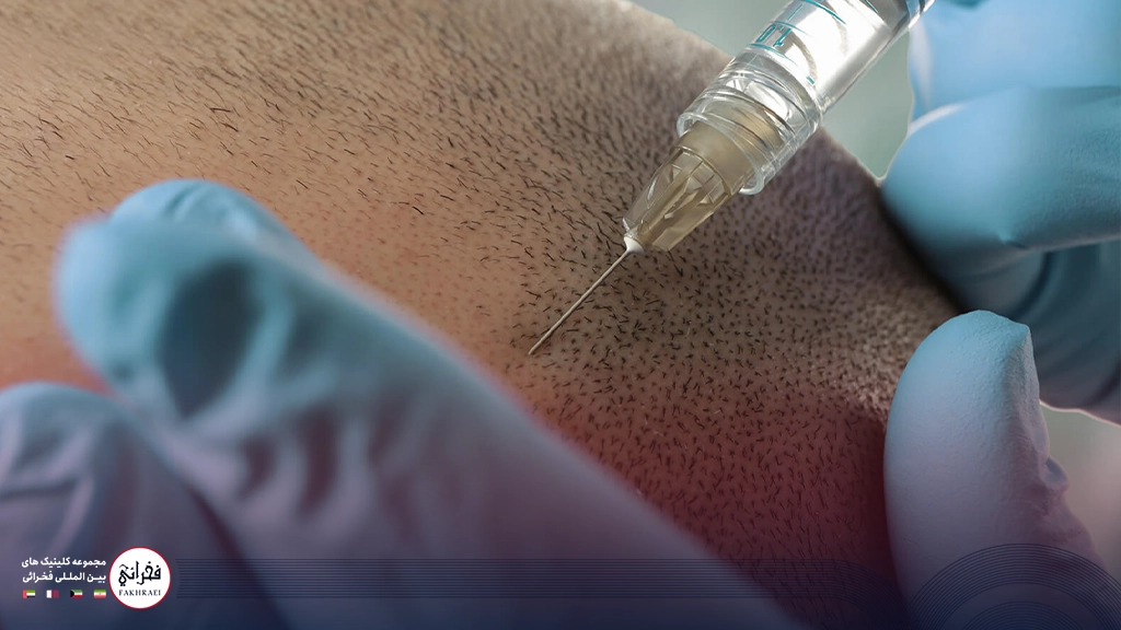 مزوتراپی ریش-مزوتراپی ریش روی صورت مردی