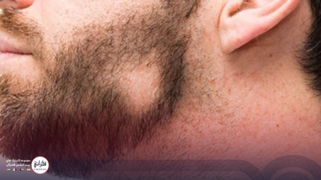 مزوتراپی ریش-مردی با ریزش ریش سکه ای