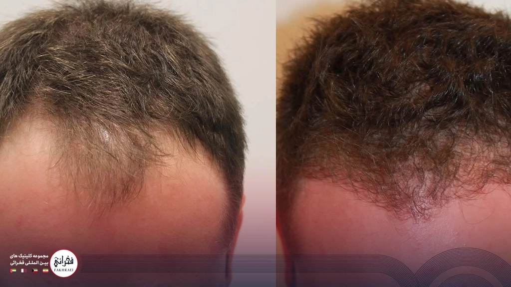 عوارض کاشت مو-قبل و بعد کاشت مو