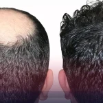 بهترین فصل کاشت مو