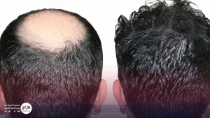 بهترین فصل کاشت مو