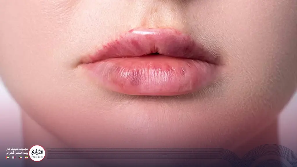 عوارض ژل لب روسی برای یک زن