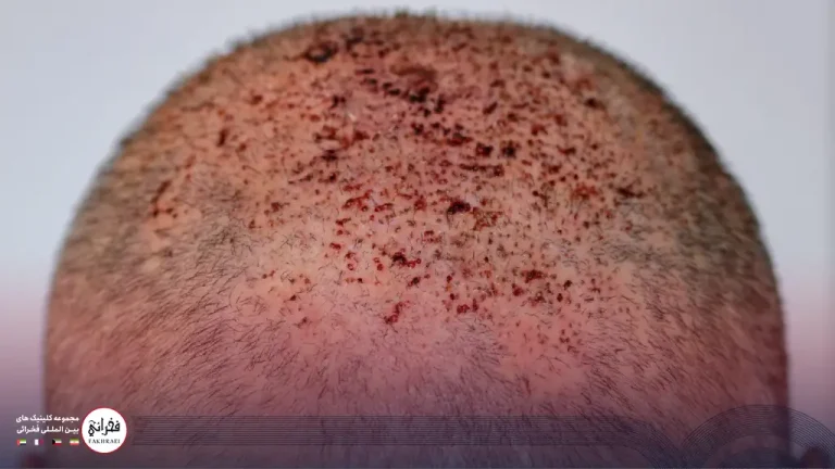 عفونت بعد از کاشت مو