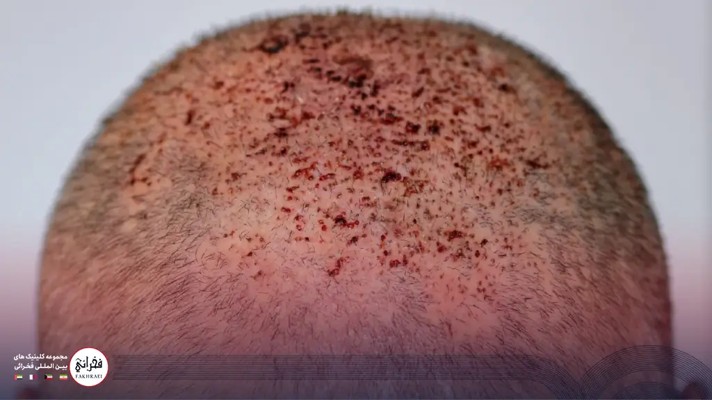 عفونت بعد از کاشت مو