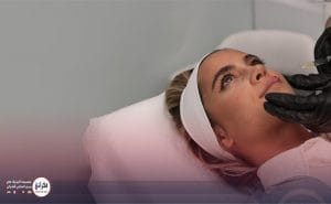 تزریق ژل لب مدل هالیوودی