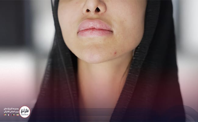 تزریق ژل لب مدل اردکی