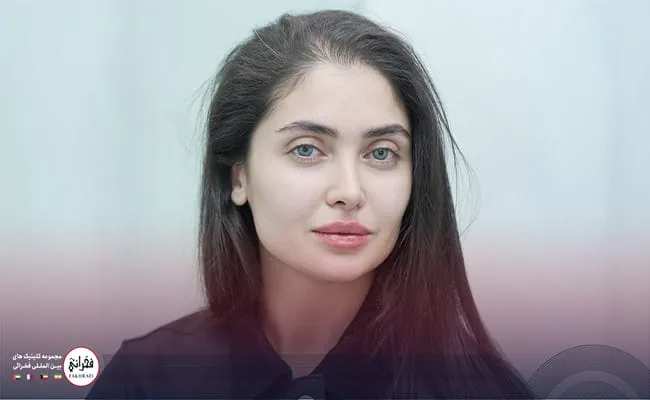 تزریق ژل لب نچرال و همه چیز در مورد مزایا و عوارض آن