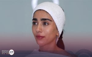 تزریق ژل لب مدل صدفی