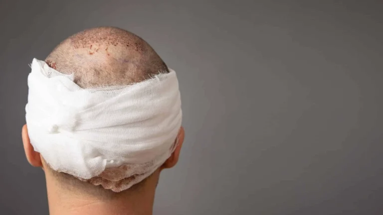 درد کاشت مو