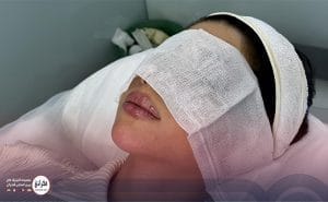 تزریق ژل لب مدل چاک دار