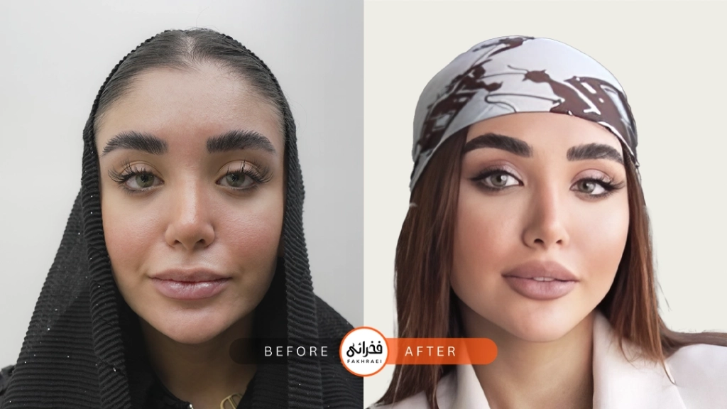 لیفت شقیقه با فیلر