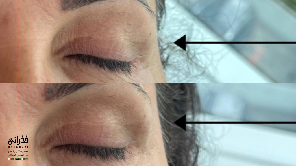 فیلر شقیقه برای چه کسانی مناسب است؟