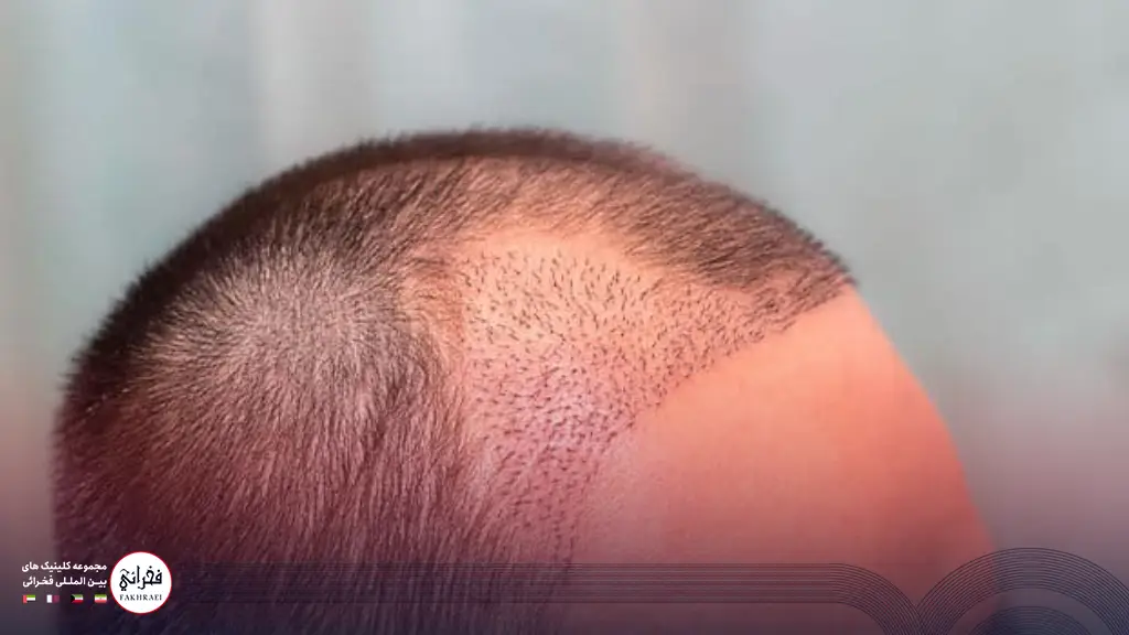 عکس ریزش مو بعد از کاشت