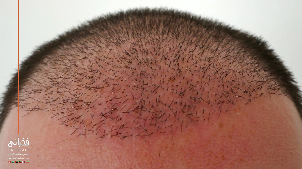 مراحل ریزش مو بعد از کاشت