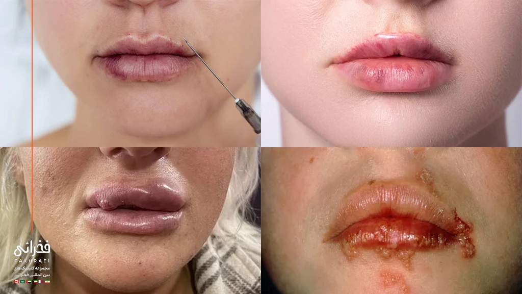 عوارض تزریق ژل لب