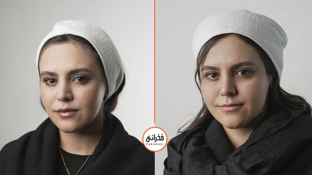 نتیجه تزریق ژل لب در کلینیک فخرائی