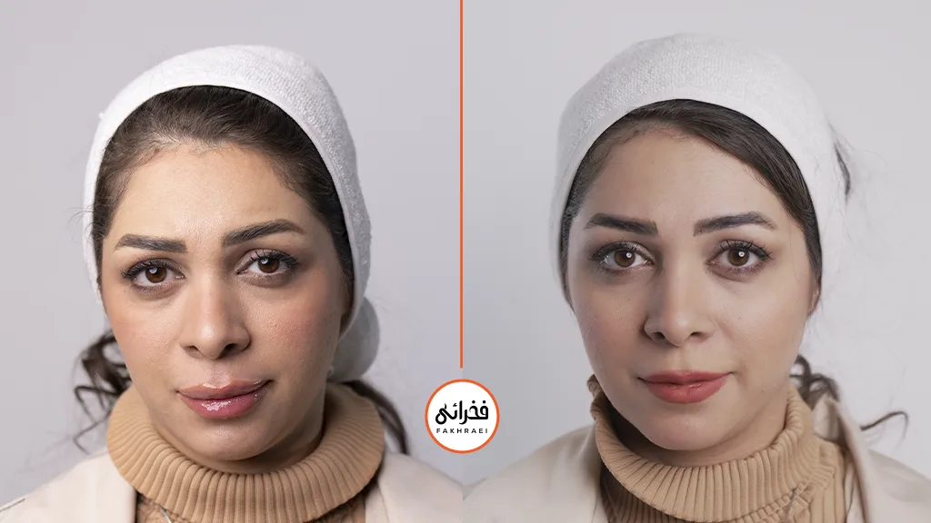 نمونه تزریق ژل لب در کلینیک فخرای