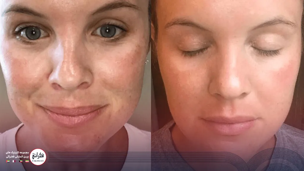 عکس قبل و بعد از پی آر پی صورت