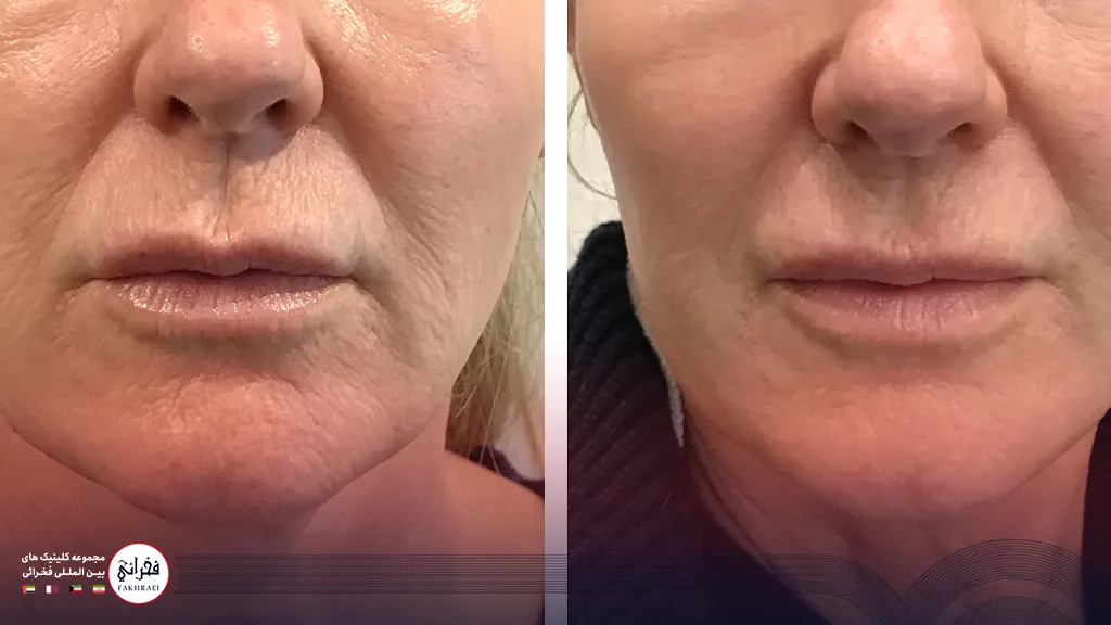 عکس قبل و بعد از پی آر پی صورت