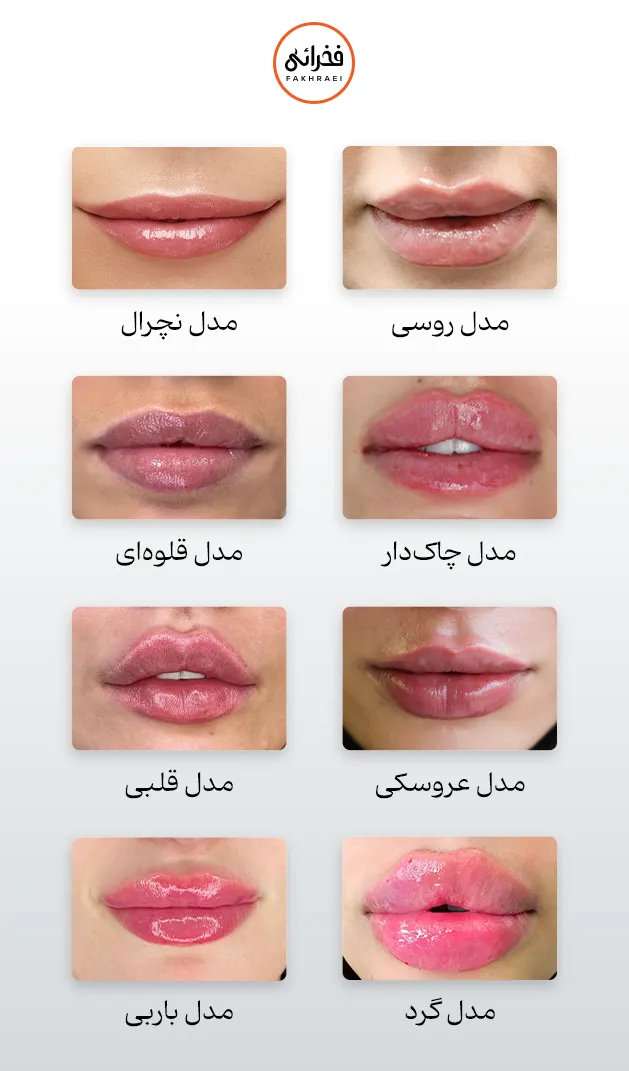انواع مدل های تزریق ژل لب
