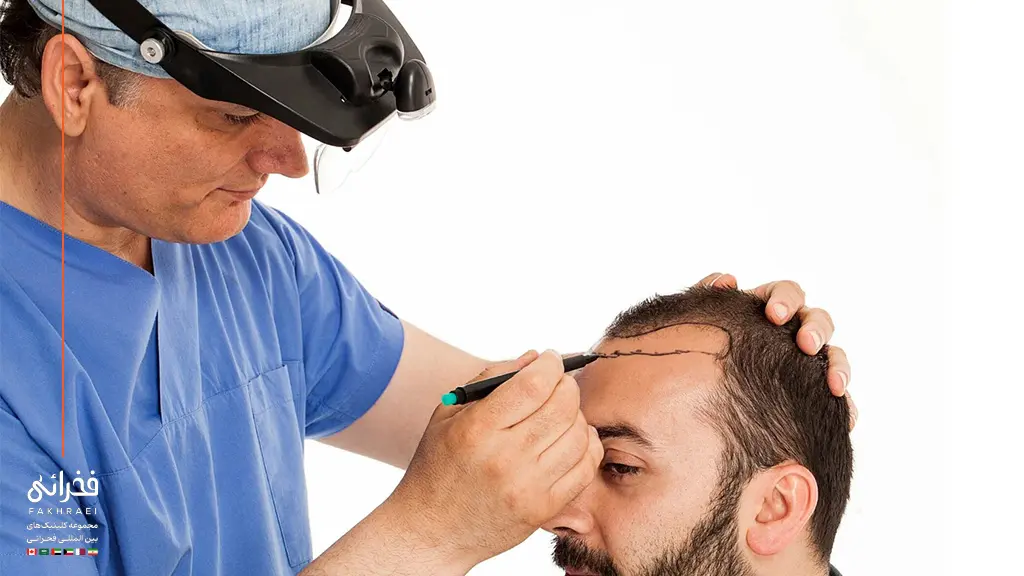 جدیدترین روش کاشت مو در ایران