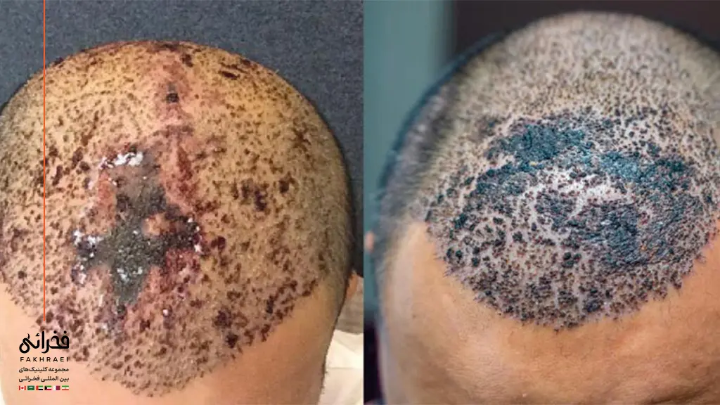 عوارض کاشت مو به روش SUT