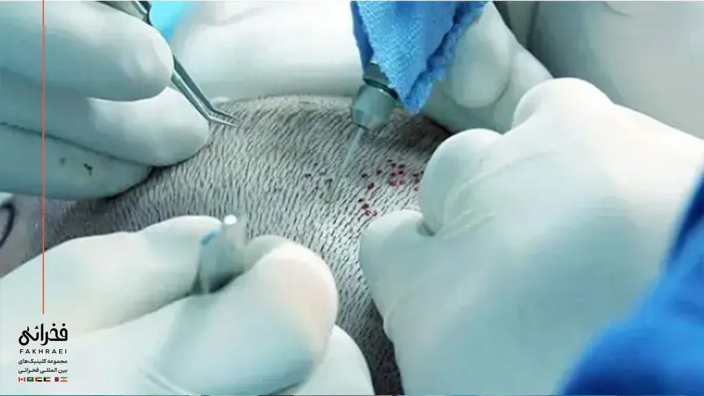 انجام جدیدترین روش کاشت مو در آمریکا