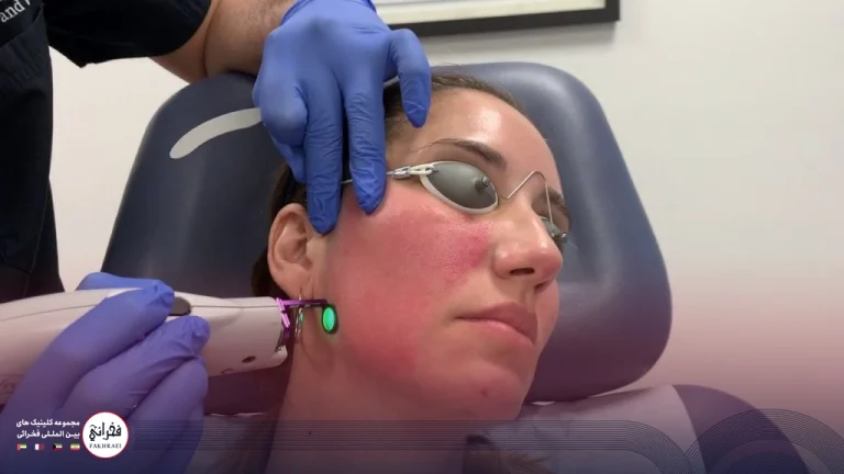 لیزر فوتونا برای منافذ باز پوست