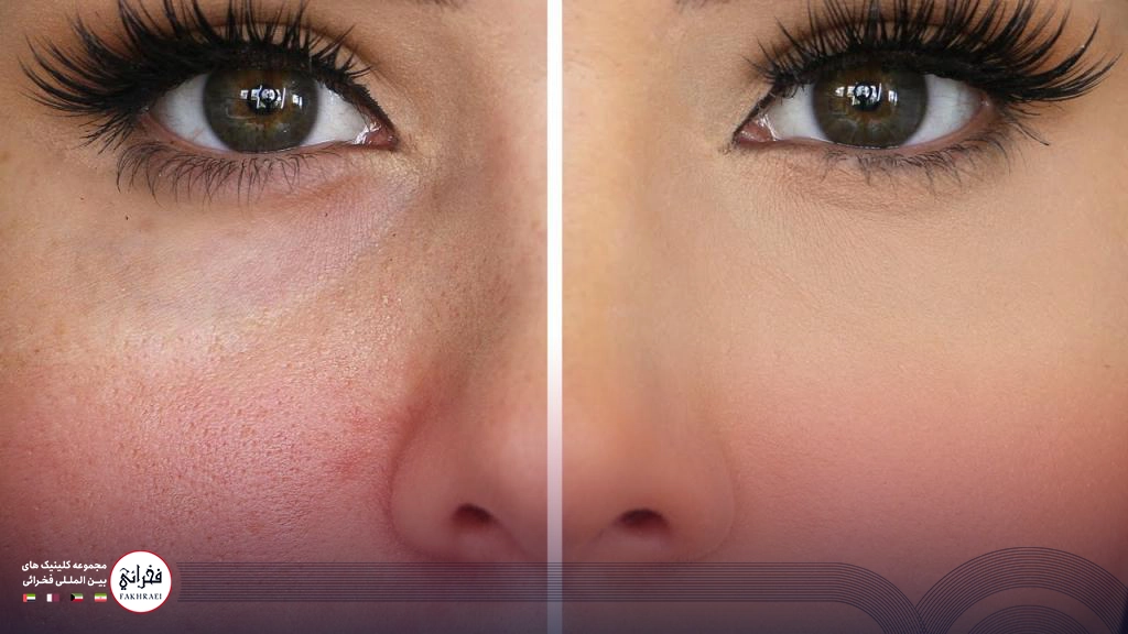 لیزر فوتونا برای منافذ باز پوست-قبل و بعد لیزر فوتونا روی پوست خانمی