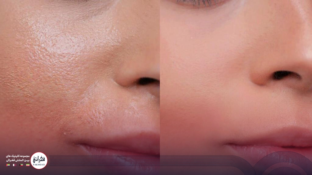 لیزر فوتونا برای منافذ باز پوست-قبل و بعد لیزر فوتونا روی صورت خانمی