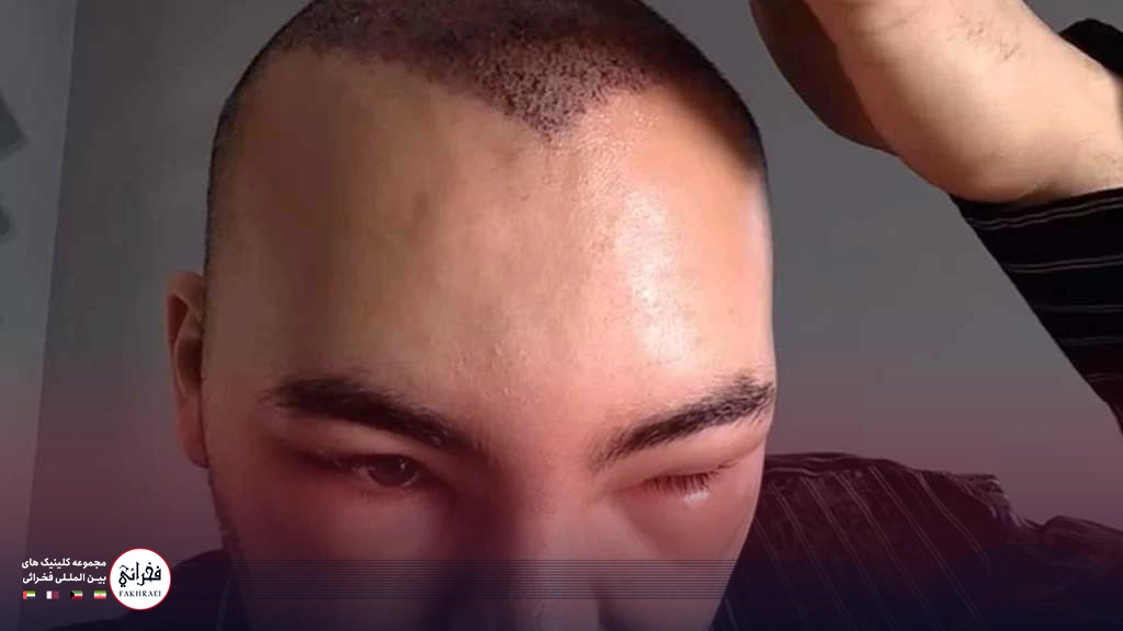 آیا ورم کاشت مو طبیعی است؟