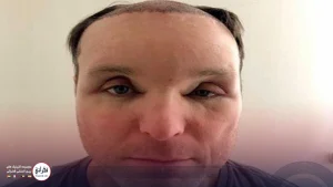 ورم بعد از کاشت مو