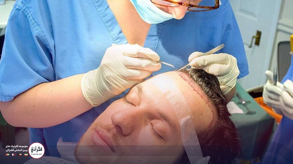 کاشت مو بدون تراشیدن سر -کاشت جلوی سر مردان