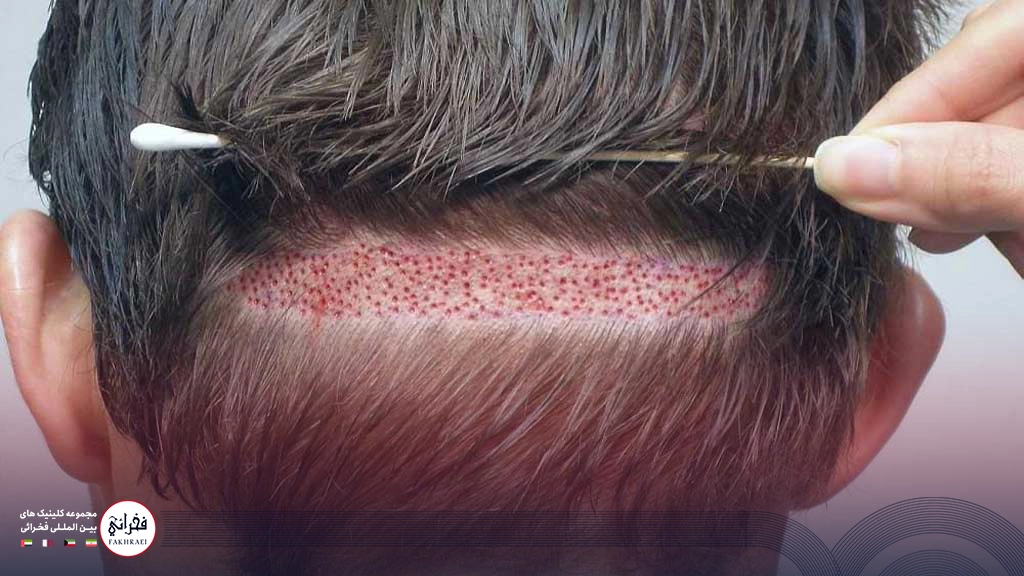 کاشت مو بدون تراشیدن سر -کاشت زیر موها