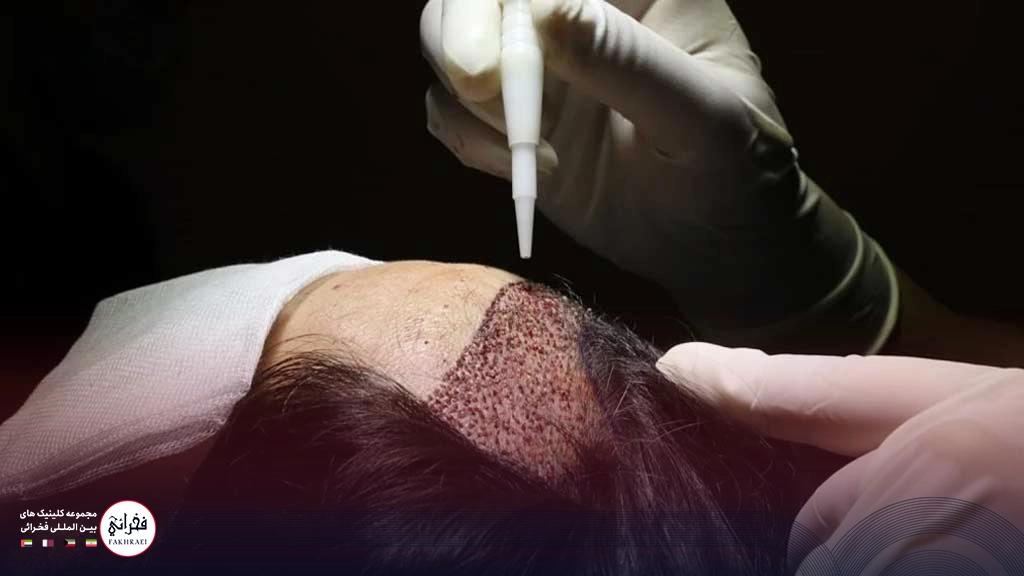 کاشت مو بدون تراشیدن سر -در حال انجام کاشت جلوی سر