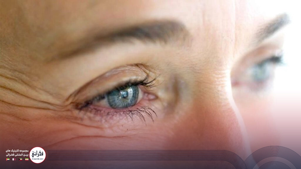 جوانسازی دور چشم-چین و چروک زیر چشم خانومی