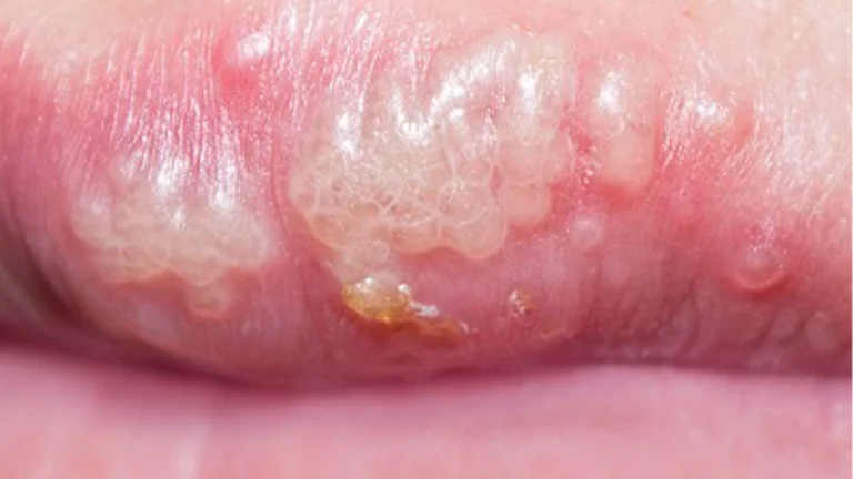 درمان تبخال در کلینیک فخرائی