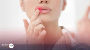 ماساژ بعد از تزریق ژل لب