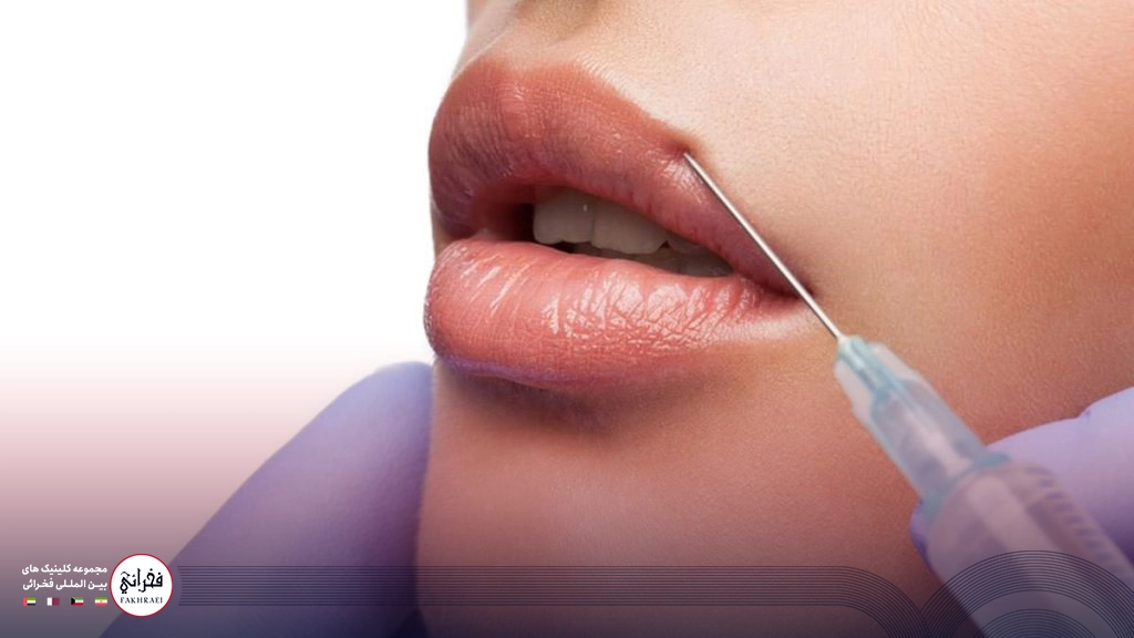 کبودی بعد از تزریق ژل لب-در حال تزریق ژل لب