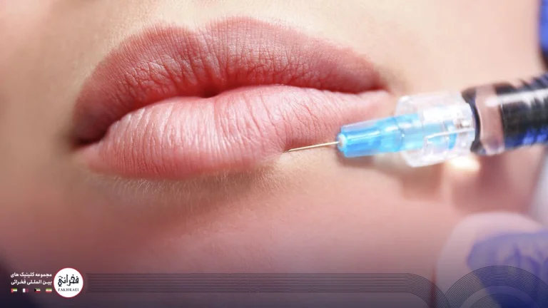 کبودی بعد از تزریق ژل لب-در حال تزریق ژل لب