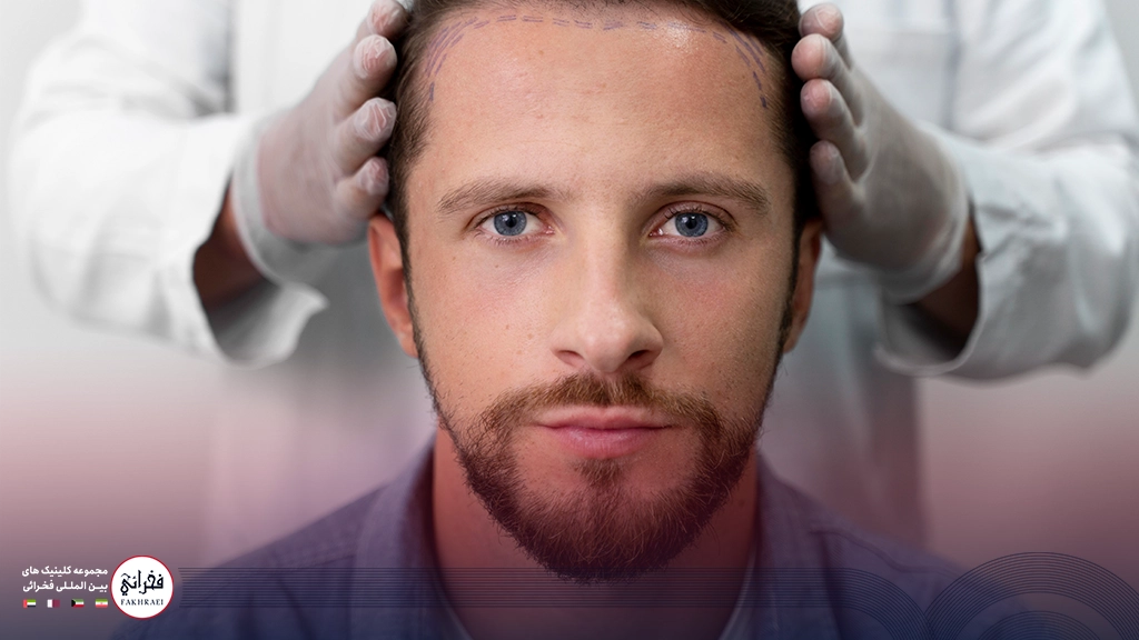 آیا کاشت مو به روش تکثیر نتیجه بخش است؟