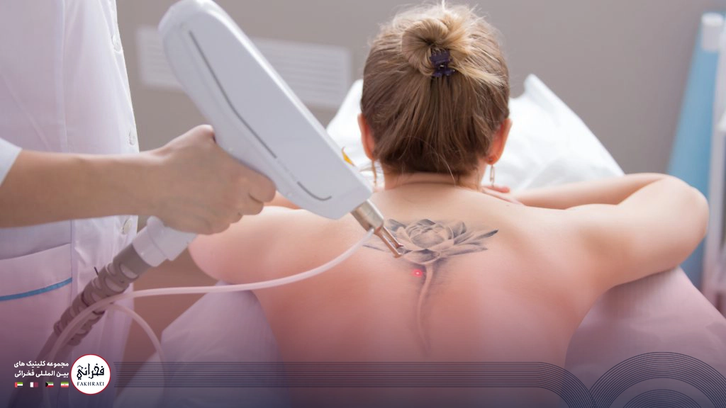 کندلا بهتره یا کلاریتی؟-در حال انجام لیزر روی تاتو پشت کمر