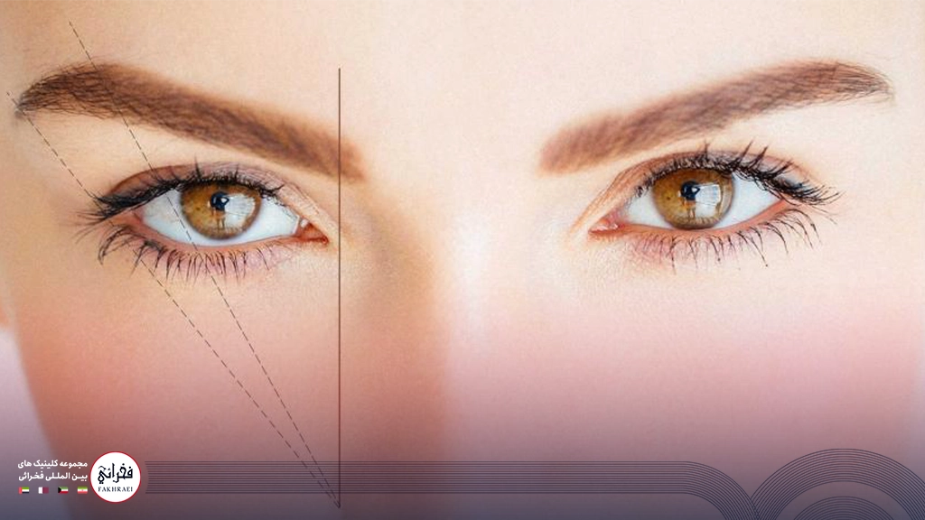 کاشت ابرو به روش FIT-خانمی با ابرو قهوه ای