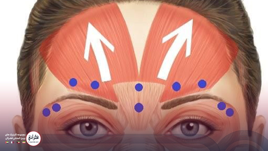 درمان افتادگی ابرو بعد از بوتاکس