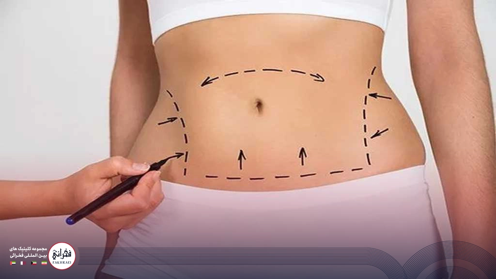 هایفوتراپی شکم-خط کشی روی شکم خانمی